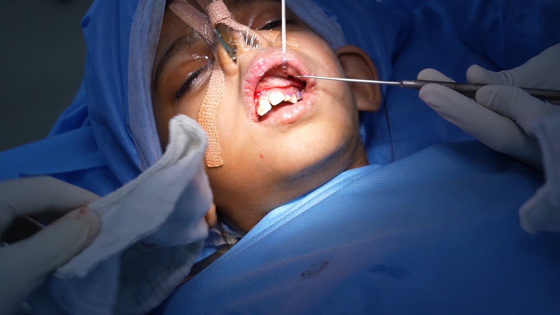Hemangioma for a baby